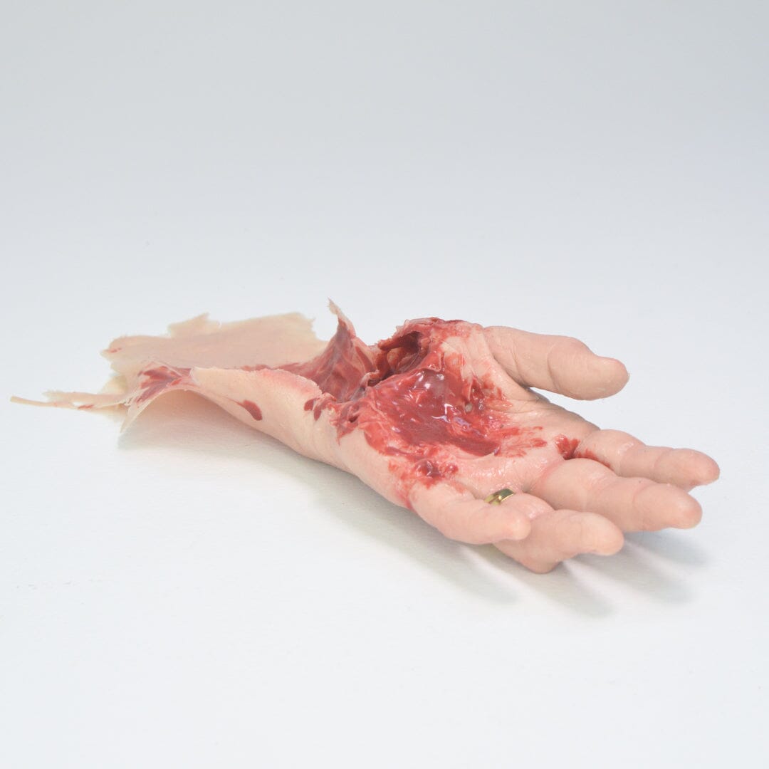 Degloved Hand Injury